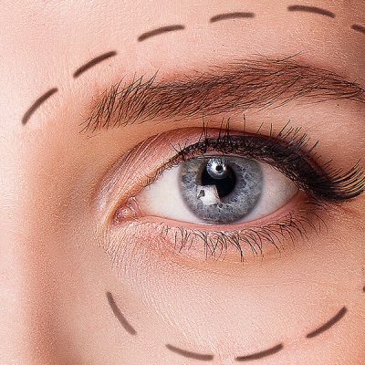 blefaroplastia (1)