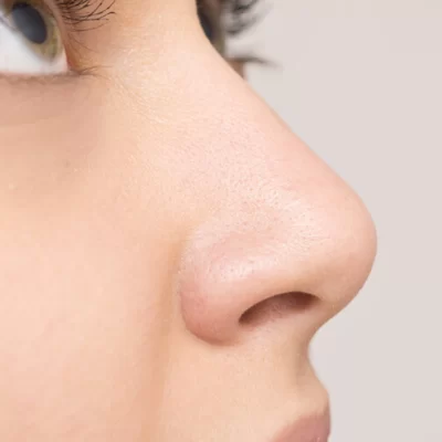 rinoplastia (1)